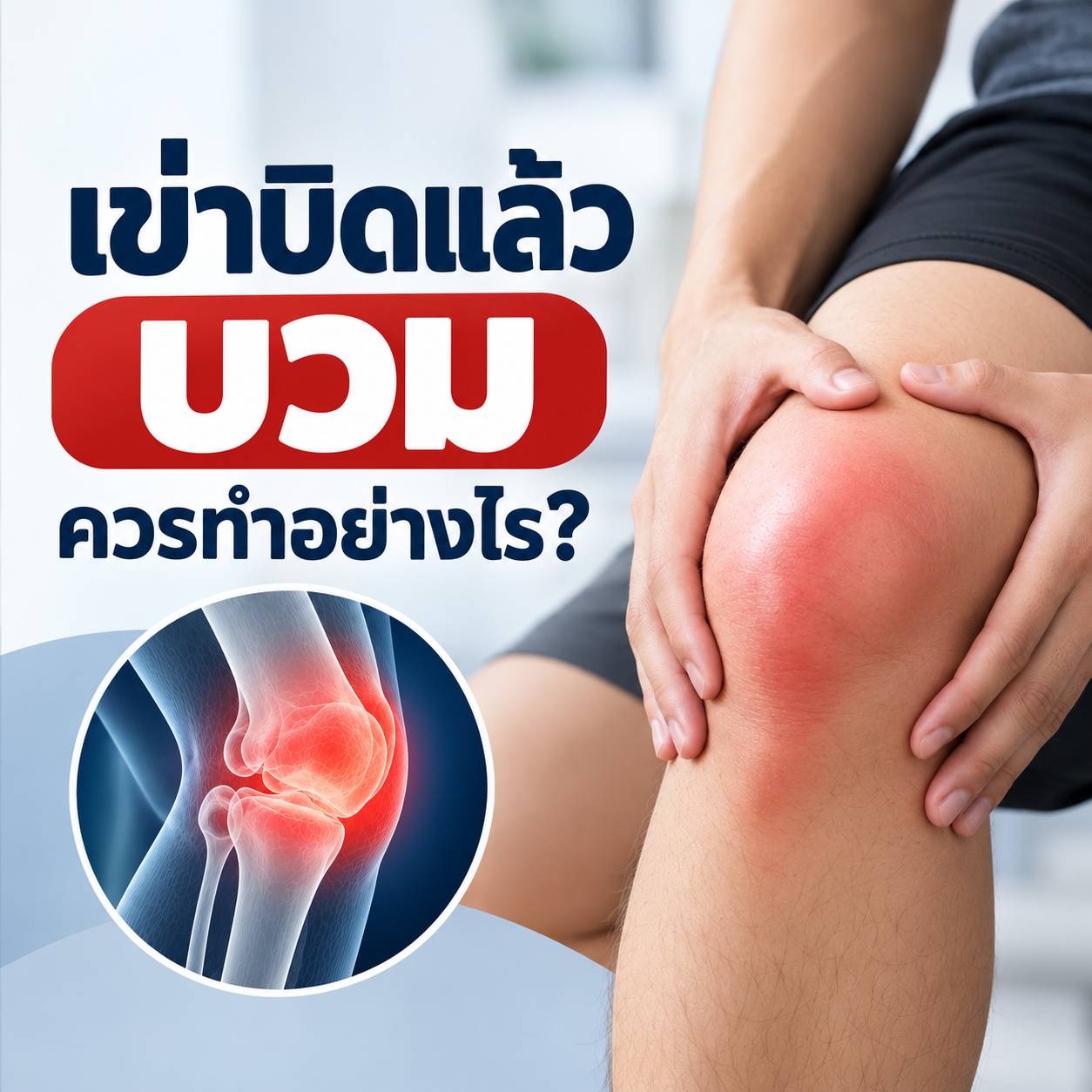 เข่าบิดแล้วบวม ควรทำอย่างไร? เช็กอาการและวิธีดูแลตัวเอง